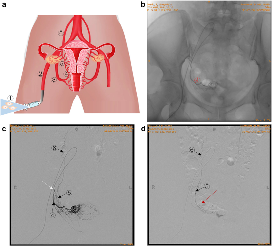 經(jīng)卵巢動(dòng)脈精準(zhǔn)輸注hAEC