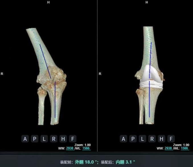 AI精準(zhǔn)關(guān)節(jié)置換
