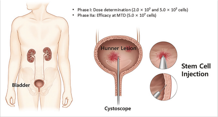間質性膀胱炎臨床試驗