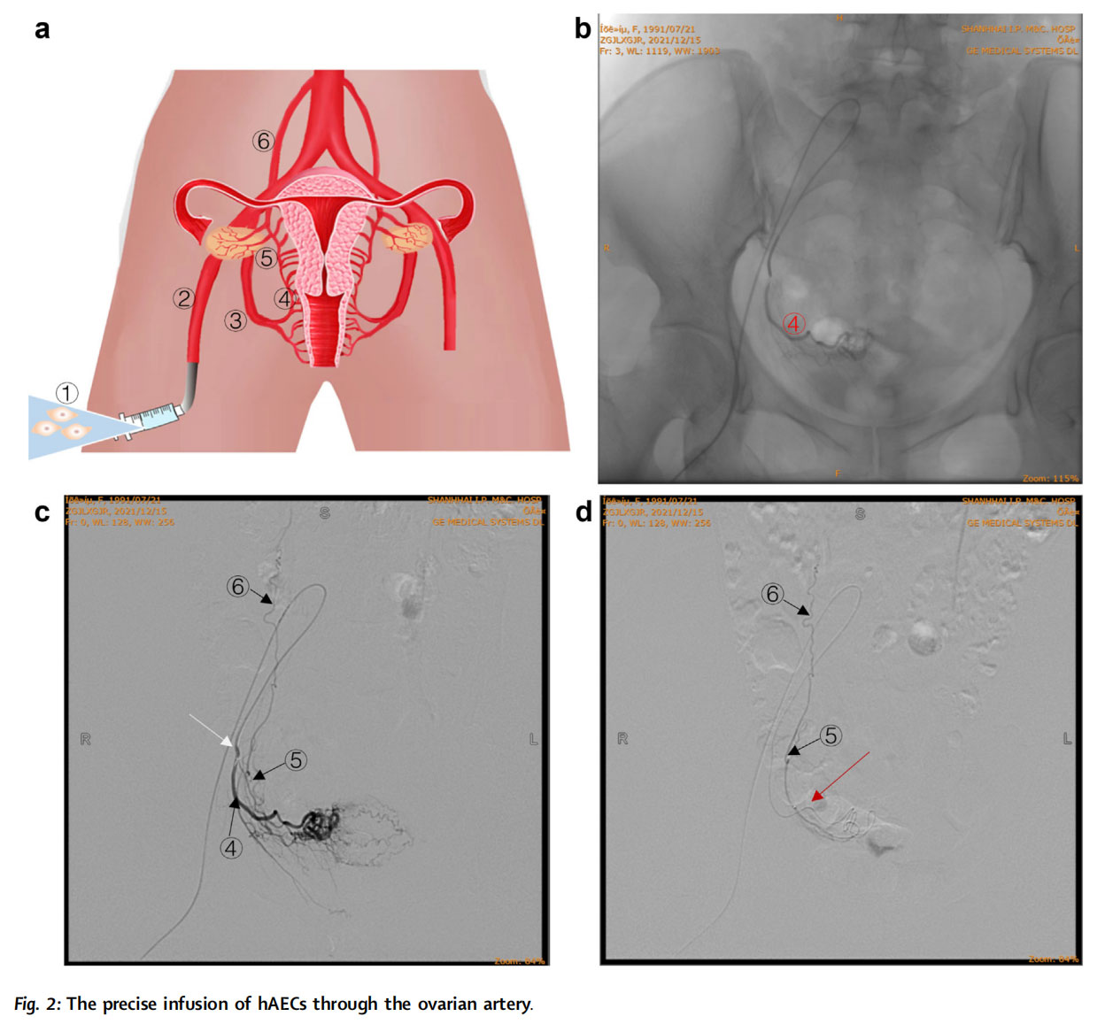 卵巢早衰臨床試驗