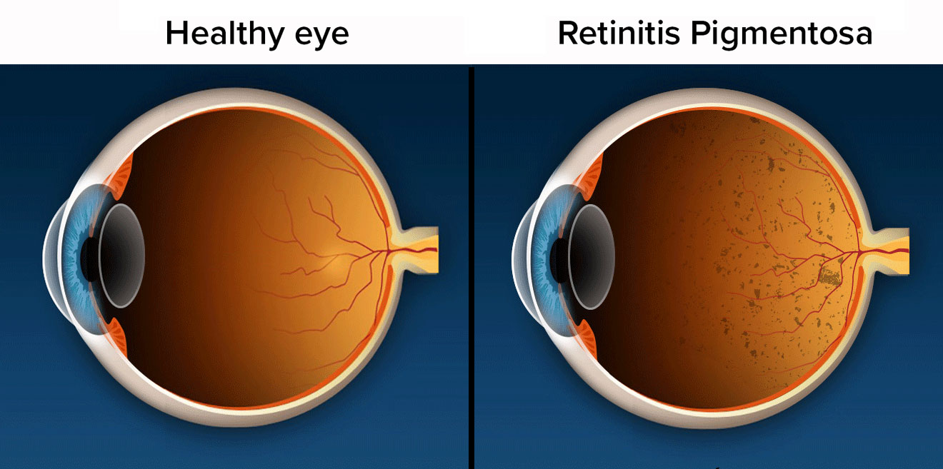 視網膜色素變性