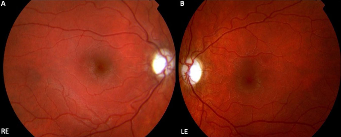 遺傳性視神經病變