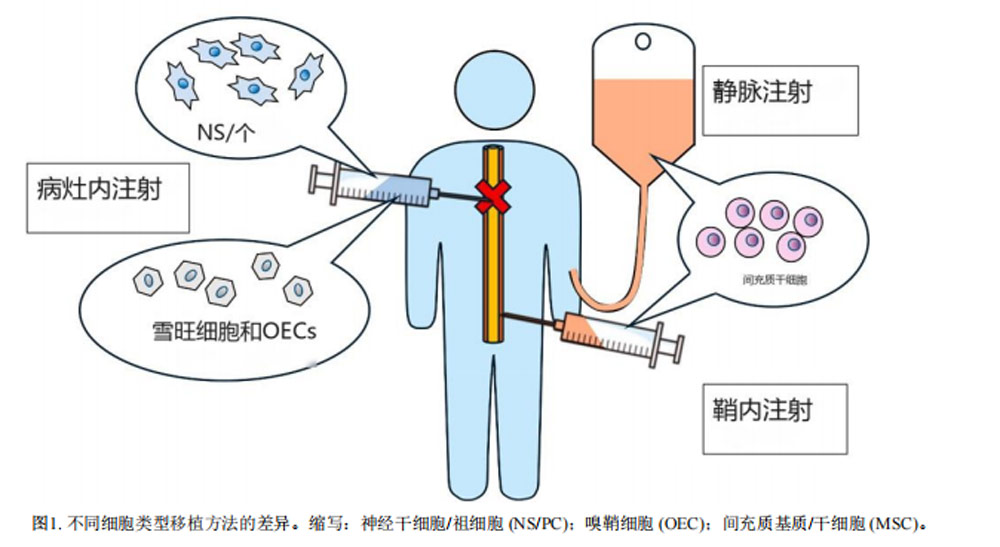 干細胞治療脊髓損傷