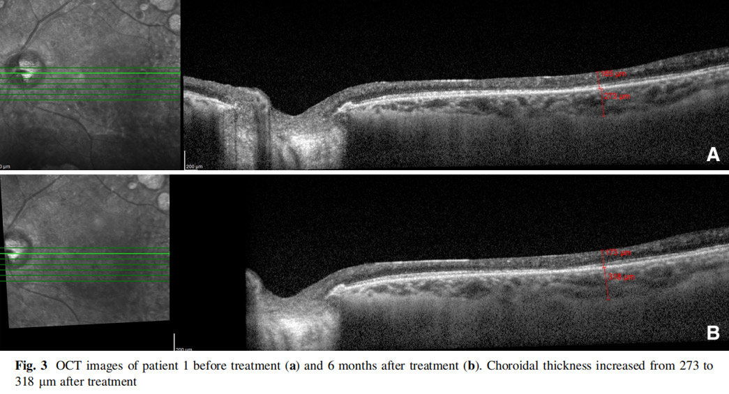 視神經萎縮臨床試驗