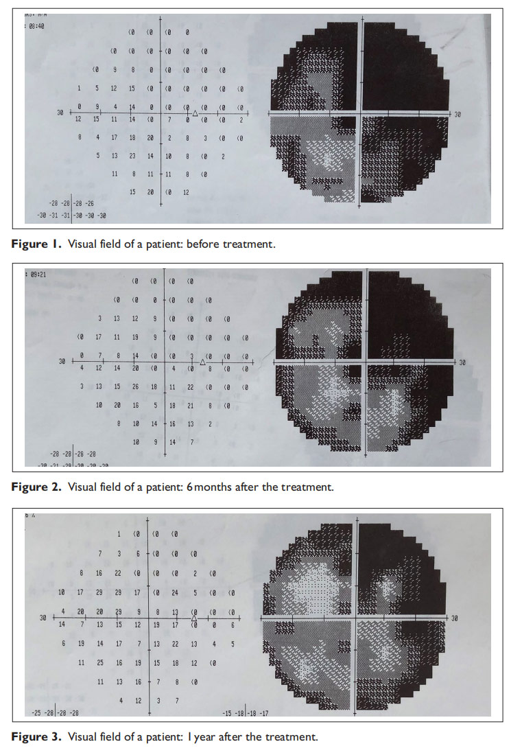 視神經萎縮臨床試驗