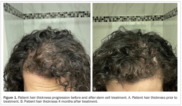 多囊卵巢綜合征臨床試驗(yàn)