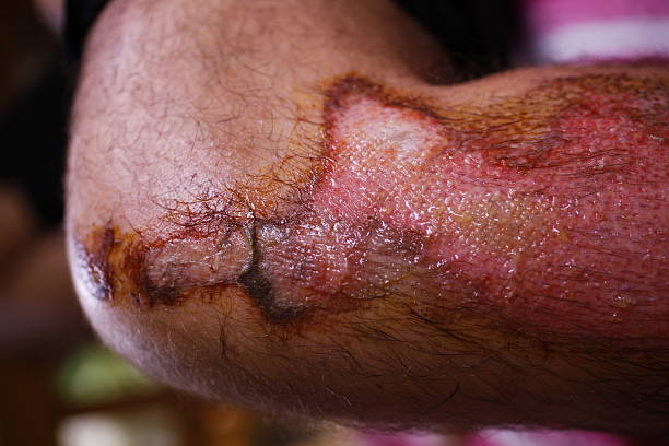 干細胞修復面部深度燒傷：1例患者術后面部基本恢復正常 | 成功案例