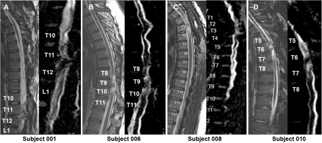 MRI頸胸T2矢狀圖和AvDC矢狀圖