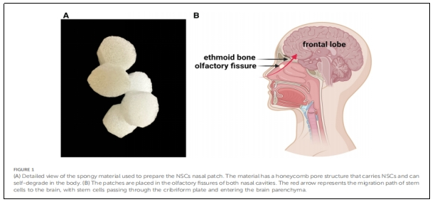 圖1：用于制備N(xiāo)SCs鼻貼片的海綿狀材料的詳細(xì)視圖。