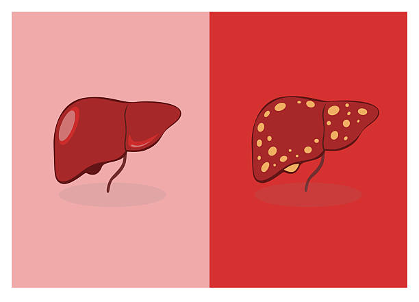 國內外干細胞治療肝硬化進展對比：哪項技術更成熟、效果更好？