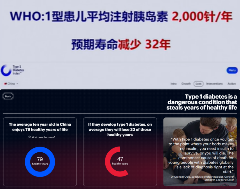 2025｜間充質(zhì)干細胞療法治療1型糖尿?。含F(xiàn)狀與臨床進展