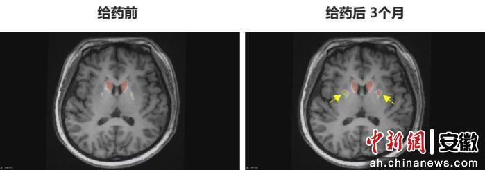 圖為李女士 PET-DAT/MRI融合圖像術前與術后三個月對比。