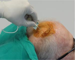 干細(xì)胞注射到大腦過(guò)程。