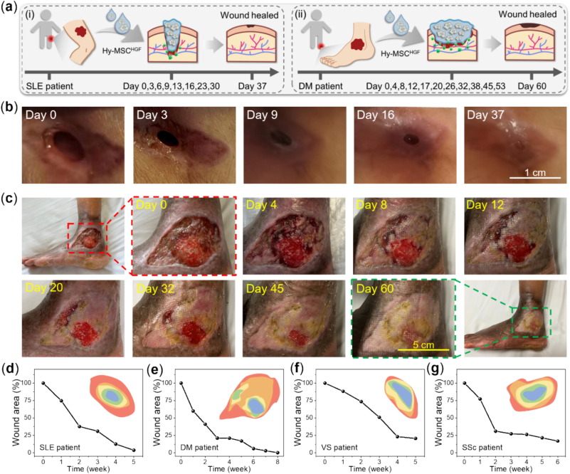 圖：MSC-HGF負載水凝膠在臨床上治愈人類RW傷口。