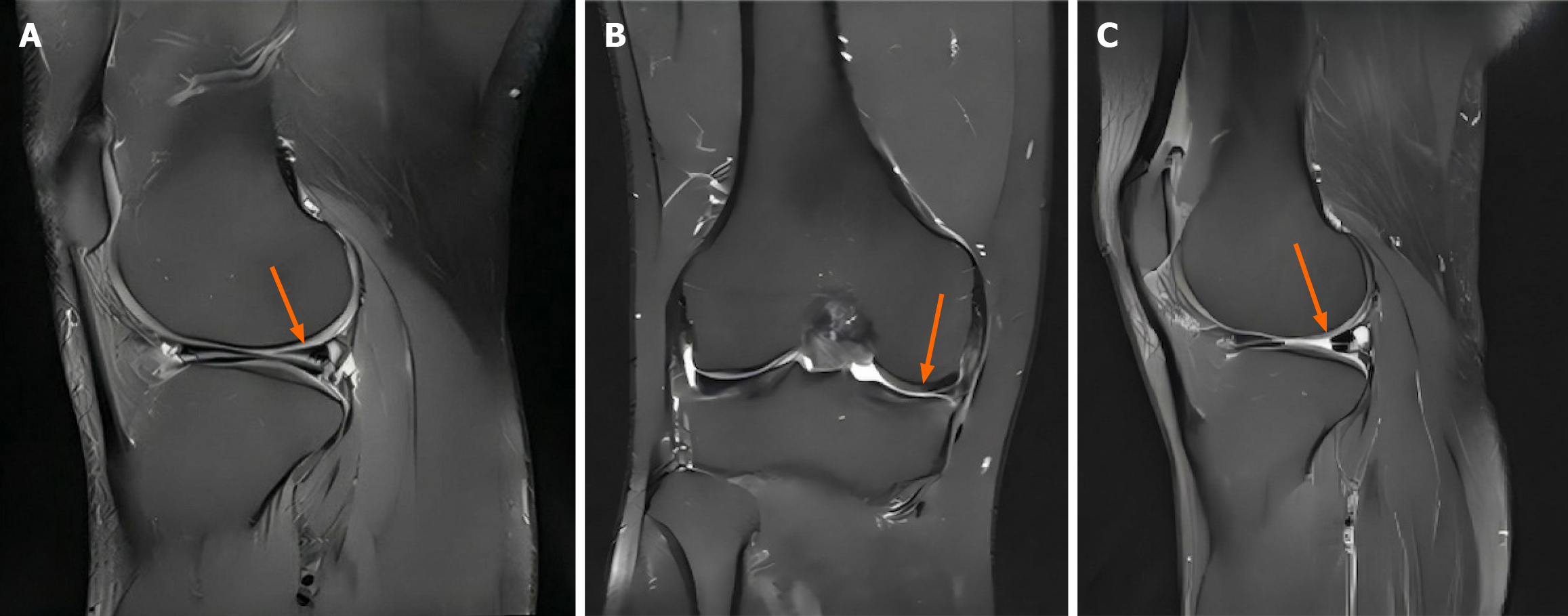 圖2：間充質(zhì)干細胞治療后半月板組織的代表性磁共振成像圖像。